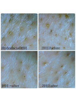 ハーシークレット(Her secret)/ハイドラ毛穴洗浄