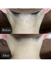 ベルフィーヌ 恵比寿店(BELFINE)/オーダーメイド脱毛