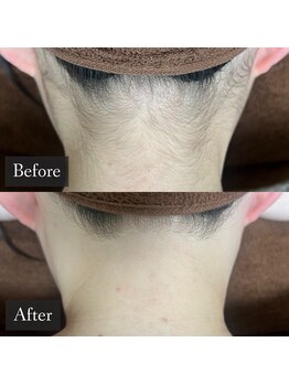 ベルフィーヌ 恵比寿店(BELFINE)/オーダーメイド脱毛