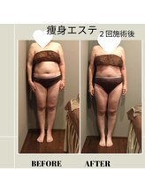 ムーン(MOON)/痩身エステ☆before→after