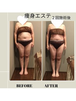 ムーン(MOON)/痩身エステ☆before→after