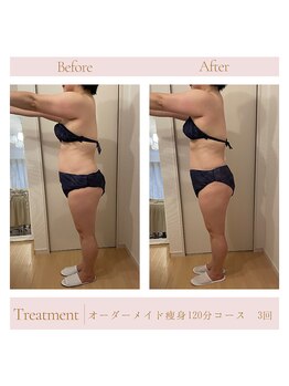 エミル(Emillu)/＊Body_ビフォーアフター