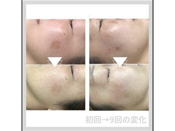 じゅえる/→続き シミケア9回の効果