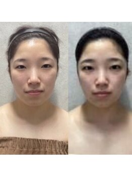 メゾン アンジュ(Maison Ange)/小顔フェイシャル/before&after