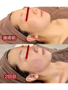エステティック ザザ 神楽坂店(ZA/ZA)/サーモフェイスビフォーアフター