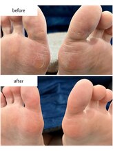 ケアプラス(care plus)/足裏角質ケア