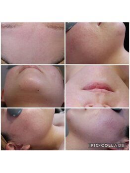 ベビースキン(baby skin)/FCRトリートメント