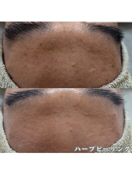 ネイルズビー 別邸(Nail's be)/メンズも肌質改善で美肌に