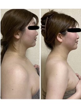 ヨサパーク オハナ(YOSA PARK ohana)の写真/【本気の二の腕ケア!むっちり二の腕撃退】ハーブ蒸し×リンパで無駄なお肉を絞って魅せる二の腕へ★