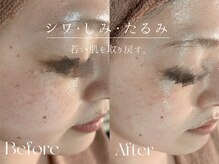 ウィハナ(wehana)の雰囲気(ピーリングを通して肌質改善/くすみ/毛穴/ニキビ/赤み)