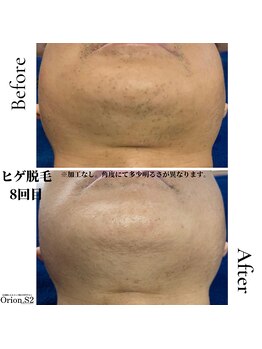 オリオンドットエスツー(Orion.S2)/【Before→After】