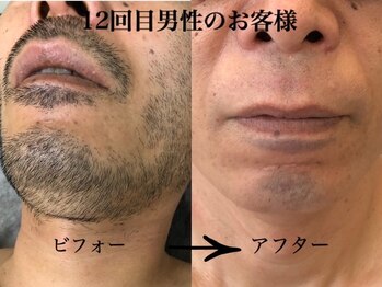 ビビ(BIBI)/ヒゲ脱毛12回目男性のお客様