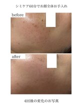 ユウドット(yuu.)/シミケア