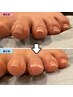 【フットネイル】巻き爪・深爪補正 ＋ 姿勢・歩行診断