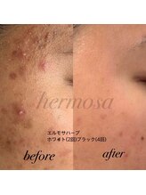 ルリミ(Relimi)/ハーブピーリング　Before After