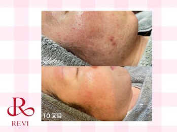 ラティーナ(Lattina)/陶肌トリートメント