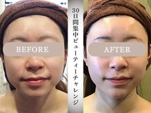 モルティープリマクラッセ 宇都宮東店(Molti Prima Classe)/たるみ/引き締め/小顔矯正/BTX