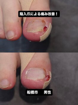 巻き爪じゅん 船橋店/巻き爪と陥入爪の痛み改善