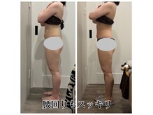 筋膜を整えて姿勢改善でリバウンドレス。ラジオ波と筋膜リリース