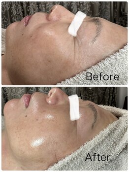 ルミネル 名古屋新栄(Luminelle)/水光ピーリング