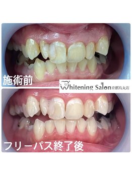 ホワイトニングサロン 京都烏丸店/ホワイトニング施術例
