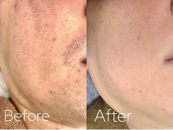 バーニー 梅田店(BARNEY)/ヒゲ脱毛　/脱毛/顔脱毛