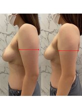 ルミエール(Lumiere)/【倉敷市】バストアップ施術事例