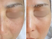 ハナコ 下通店(HANAKO)/【シミ改善】