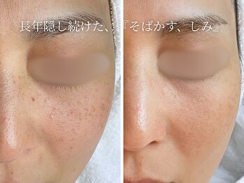 ハナコ 下通店(HANAKO)/【シミ改善】