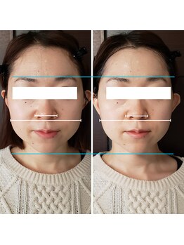 きしの美容整体院の写真/【老廃物を流してスッキリ小顔に◎】美容整体院が施術する本格小顔エステ/年齢による"たるみ"が気になる方