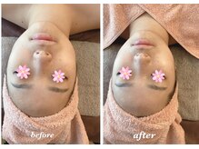 アンフィニ(infini)/フェイシャル短期集中コース