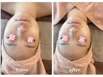 アンフィニ(infini)/フェイシャル短期集中コース