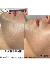オリオンドットエスツー(Orion.S2)/【Before→After】