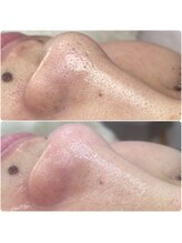 プアラ(puala)/エクストラクション