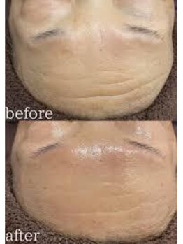 ニュイブラーシュ(nuit blanche)/深く刻まれたおでこのシワ改善♪