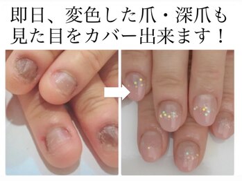 トイロ(toiro)/人口爪で見た目をカバー！