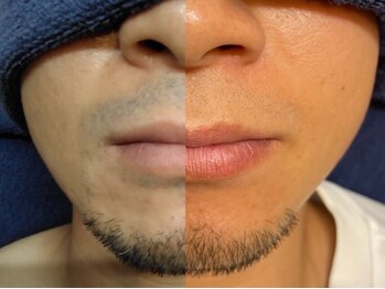 メンズオーシャンブルー/ヒゲ症例3