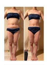 ヨサパーク ハット(YOSA PARK HAT)/２ヶ月で驚きの変化