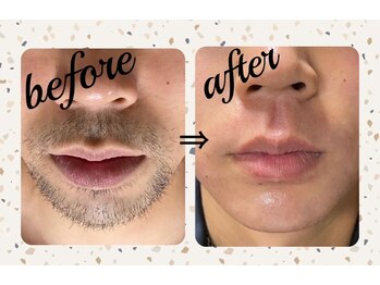 グロウ(Grow)/【メンズ人気No.1部位】ヒゲ脱毛