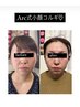 短時間で即効小顔ちゃんに☆小顔コルギ＋EMS