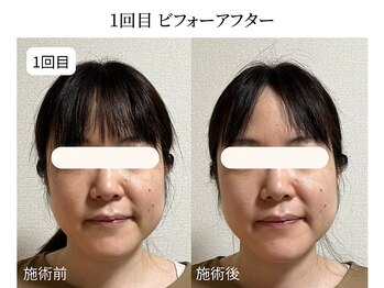 ドリームスパ 町田店(DREAM SPA)/小顔before→after