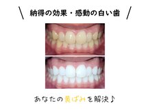 アナタのお悩みを根本から解決♪/福山市ホワイトニング