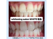 ホワイトニングサロン ホワイト(WHITE)/セルフホワイトニング/大阪/福島