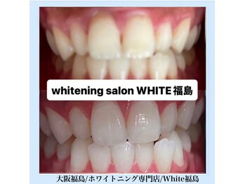 ホワイトニングサロン ホワイト(WHITE)/セルフホワイトニング/大阪/福島