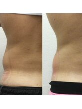 ビーレボリューション(B-REVOLUTION)/男女利用可！腰肉にもおすすめ☆