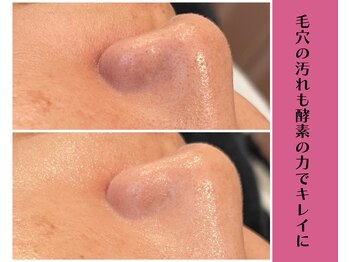 ヴィータ(VITA)/陶肌トリートメント