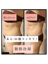 ティアメディカル(Tia Medical)/脂肪冷却