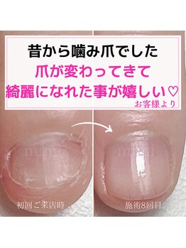 ミミ(mimi)/噛み爪がなくなりました！