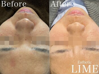 ライム 心斎橋(LIME)/ ハーブピーリング｜毛穴/ニキビ