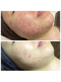 リラーナ(Re rana)/大人ニキビケア♪